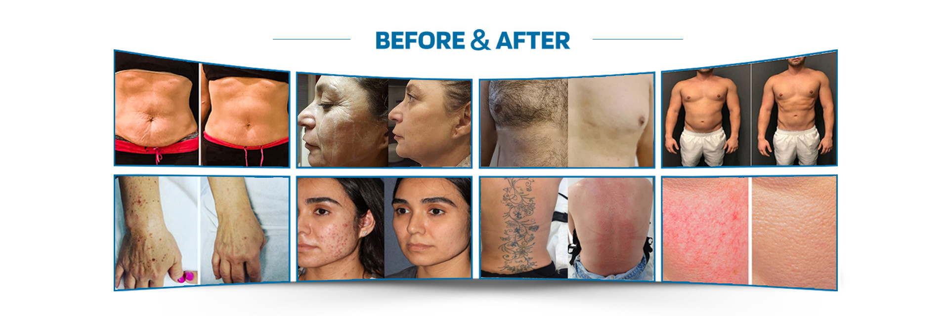 کیفیت دستگاه لیزر موهای زائد کارخانه